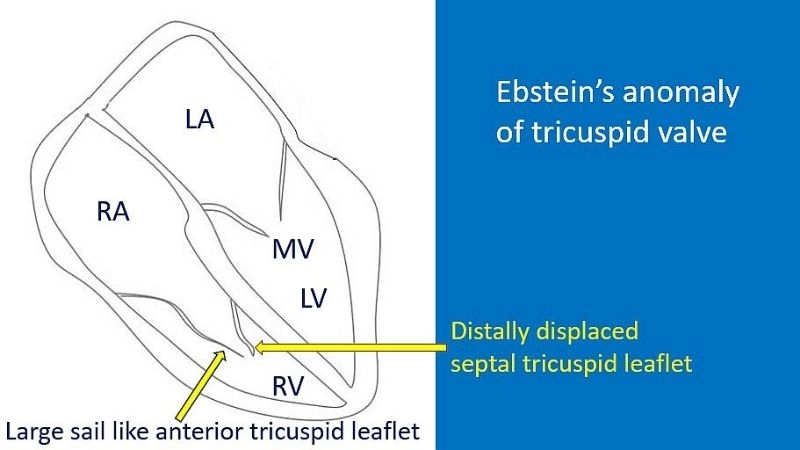 Ebstein's anomaly survival rate prognosis and outlook