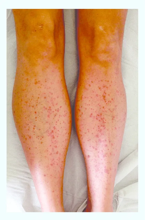 Discussing potential long term effects of echovirus