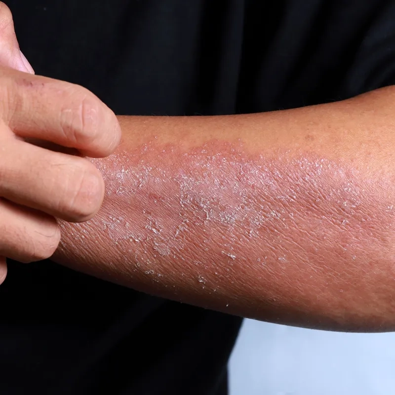 Chart showing the common types of eczema