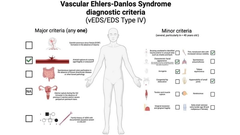 Recognizing vascular Ehlers-Danlos syndrome symptoms