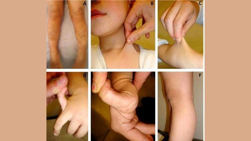 Risks in vascular Ehlers-Danlos syndrome and pregnancy