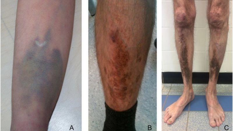 Common sign of Ehlers-Danlos syndrome easy bruising