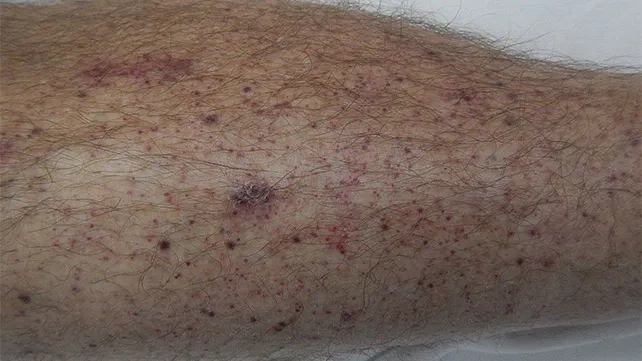 A clinical example in our ehrlichiosis rash pictures gallery
