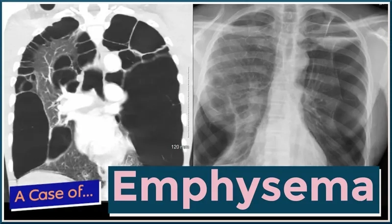 Medical comparison of emphysema vs COPD