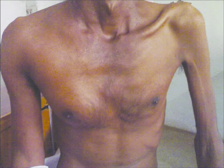 X ray image of bullous emphysema