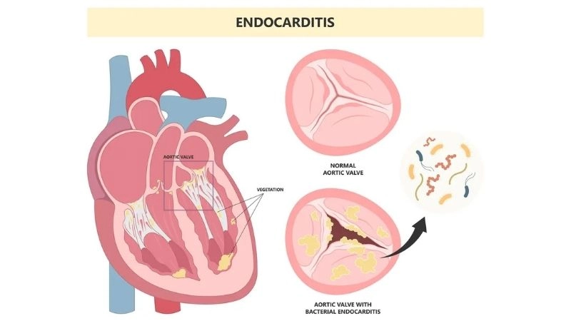 Endocarditis treatment uses antibiotics or surgery
