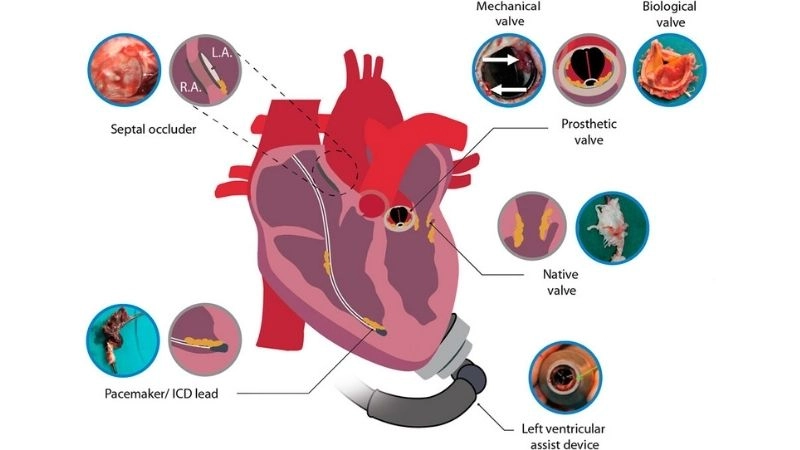Infective endocarditis caused by bacteria or fungi