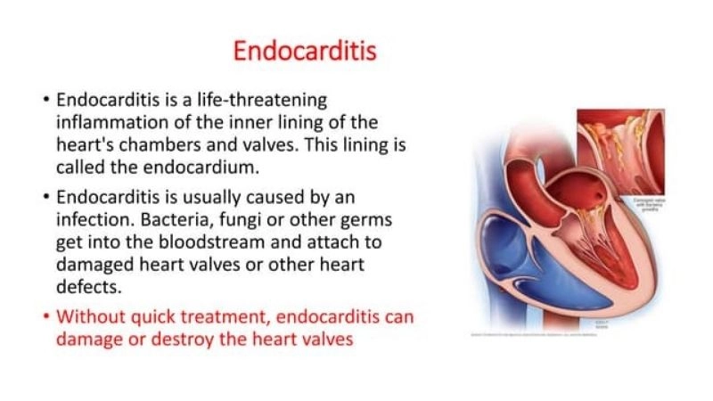 Endocarditis complications include stroke and heart failure