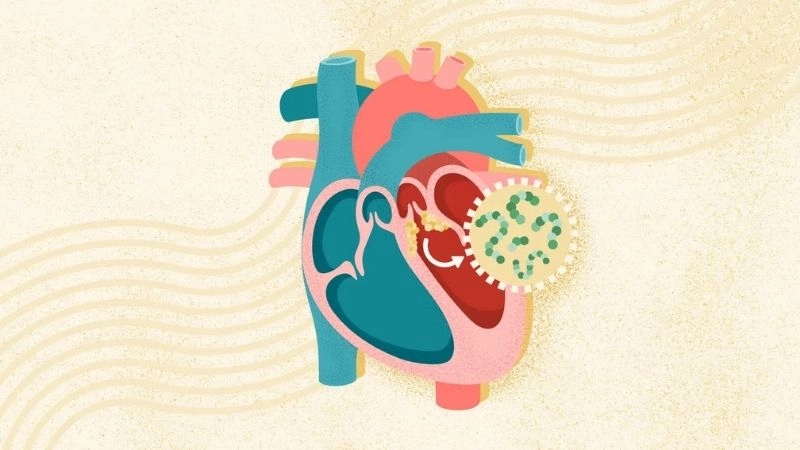 Causes of endocarditis are infections and poor oral health