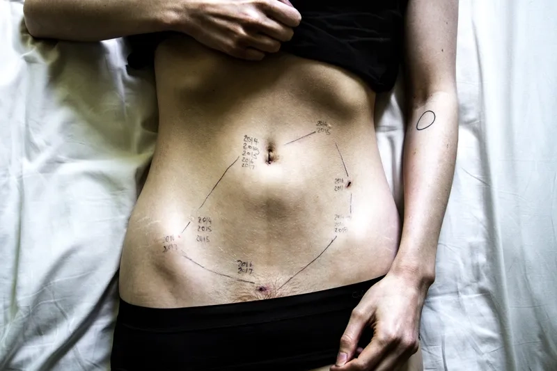 A medical chart listing the key signs of endometriosis