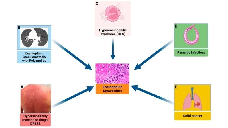 Causes of eosinophilic myocarditis underlying triggers of condition