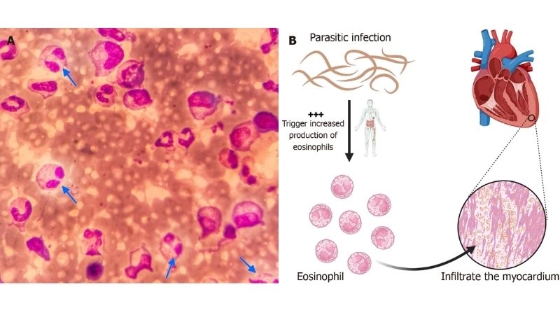 Eosinophilic myocarditis treatment medical and supportive therapies