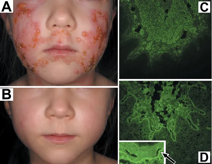 A doctor reviewing EBA symptoms on a patient's skin