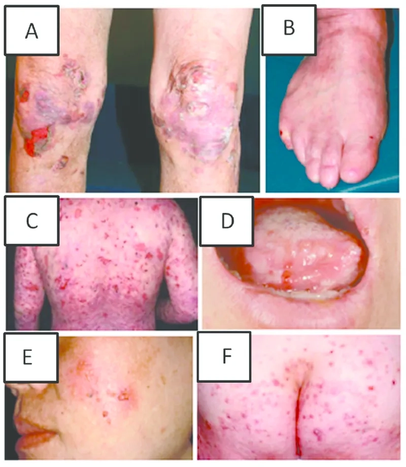 A patient's guide to living with EBA disease