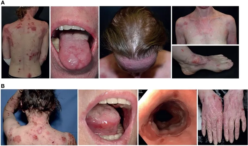 A close-up photograph of EBA skin blisters