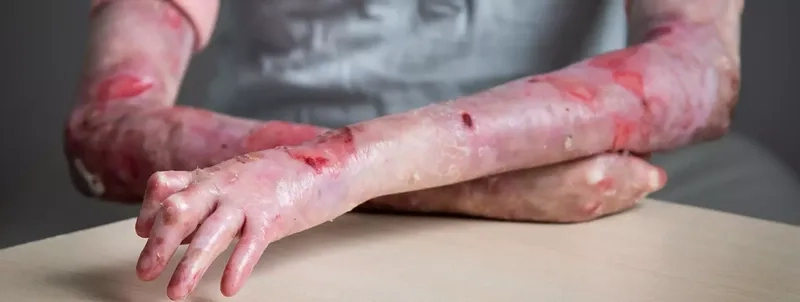 Infographic on what causes epidermolysis bullosa acquisita