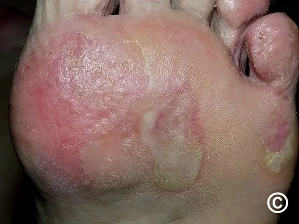 Clinical pictures of epidermolysis bullosa acquisita