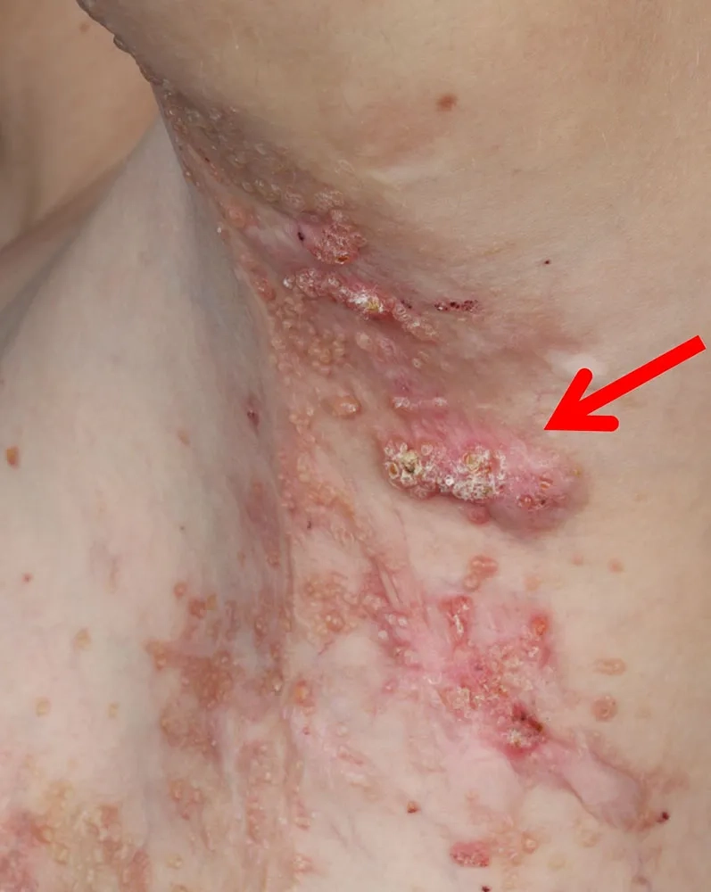 Effective treatment for erysipelas shown here