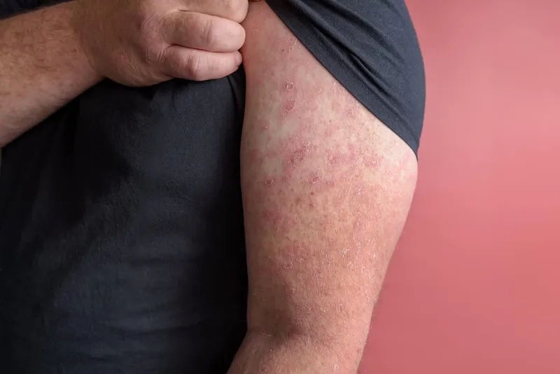 Comparing erysipelas vs cellulitis pictures