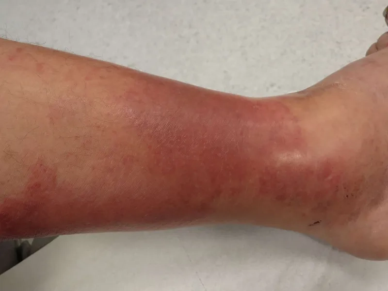 A visual guide to what causes erysipelas