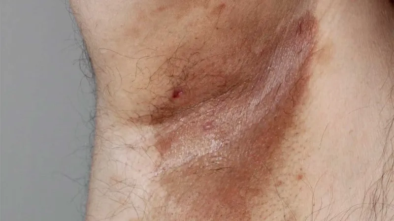 Erythrasma vs fungal infection differences