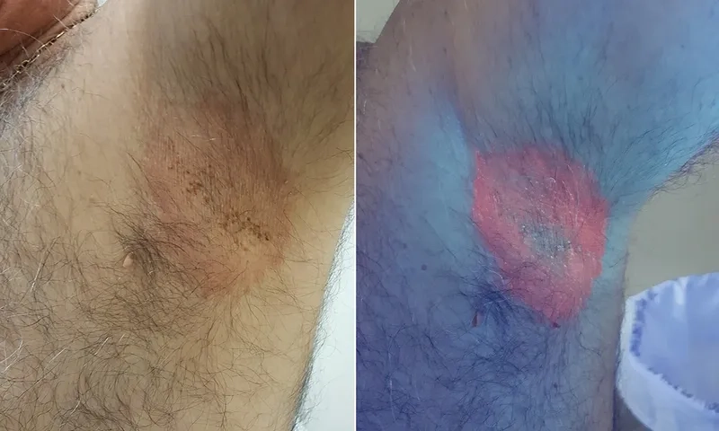 Recognizing the common Erythrasma symptoms