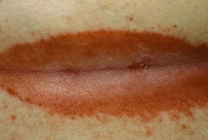 Close-up of Erythrasma in the groin area