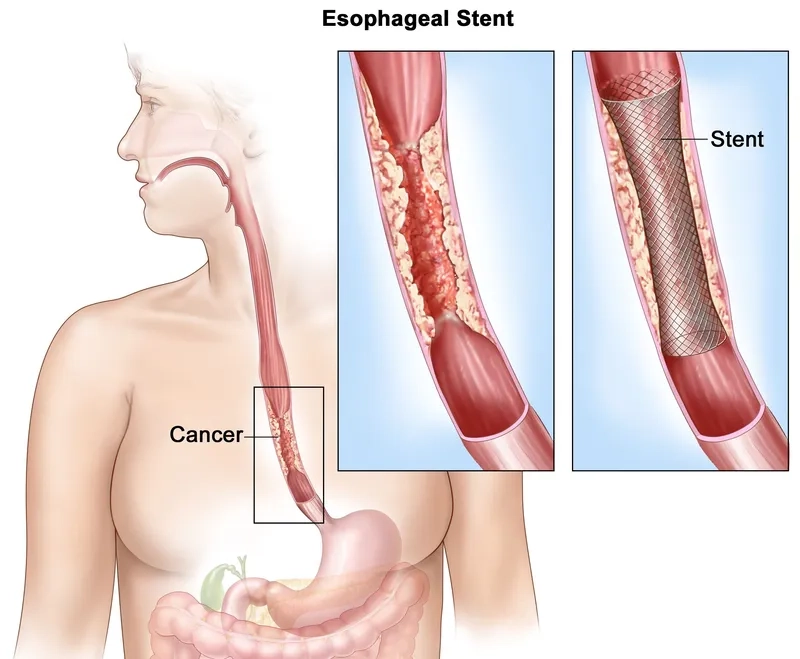 Esophageal cancer symptoms visible in medical diagnostic imaging
