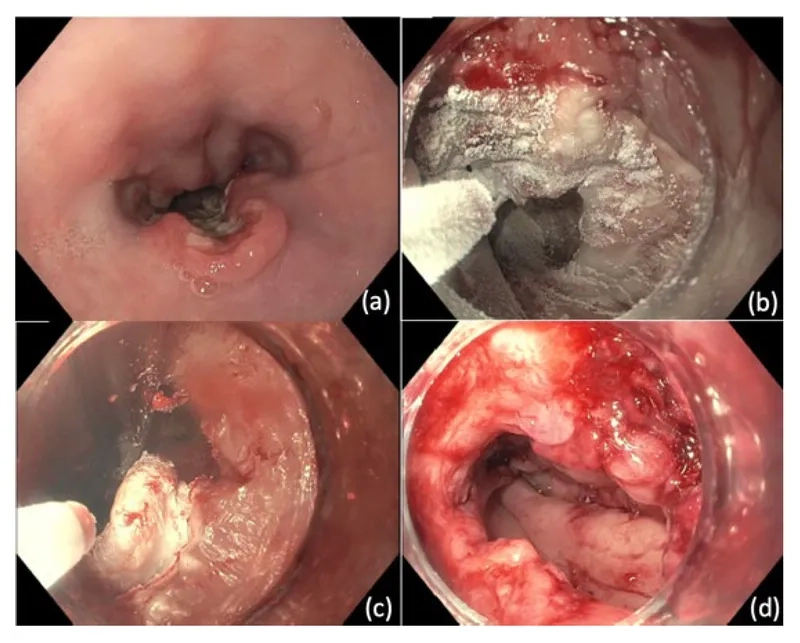 Squamous cell carcinoma of esophagus in medical biopsy image