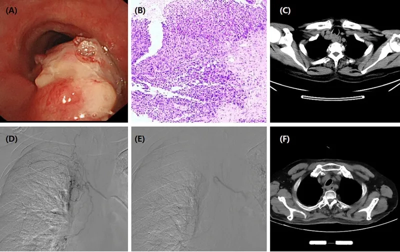 Causes of esophageal cancer illustrated in health risk diagram