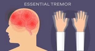 A visual guide to essential tremor symptoms