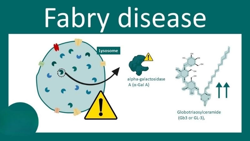 Fabry disease treatment options explained