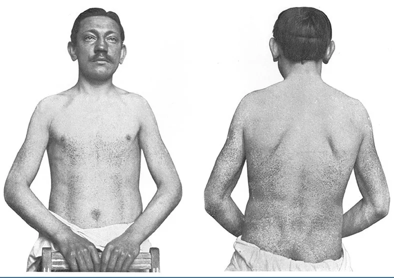 Fabry disease diagnosis through medical tests