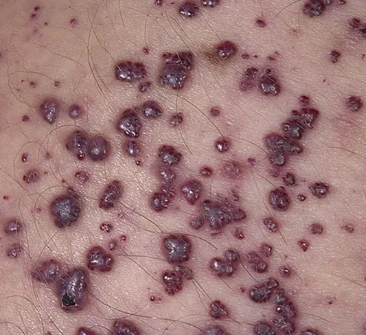 Fabry disease life expectancy considerations