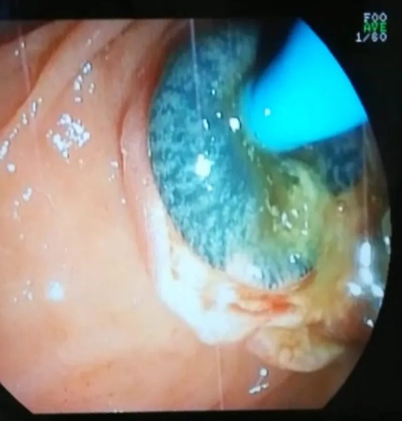 The Cycle of Transmission of Fascioliasis