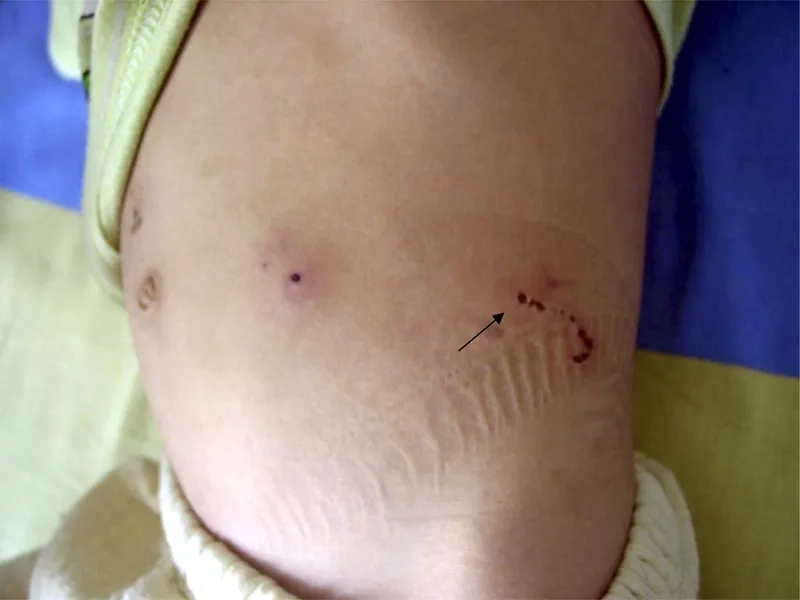 The Risk of Eating Watercress from Infected Areas