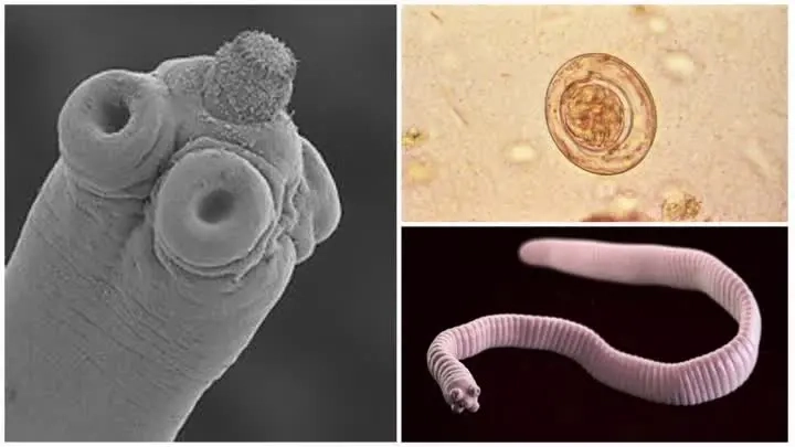 Recognizing Common Fascioliasis Symptoms