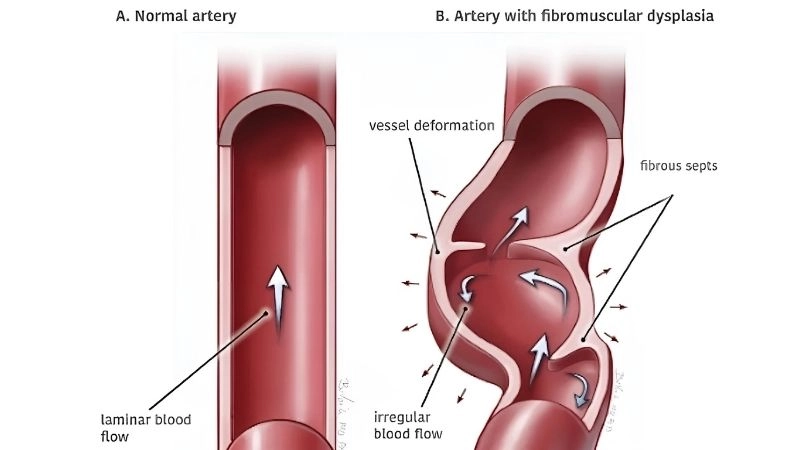 Fibromuscular dysplasia symptoms affecting arteries
