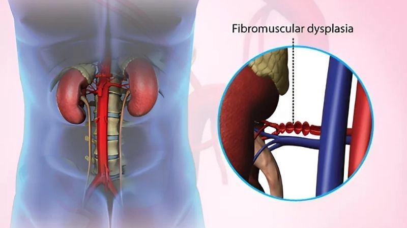 Fibromuscular dysplasia and SCAD strong connection