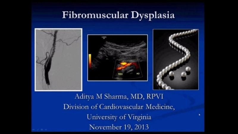 Renal artery FMD leading to secondary hypertension