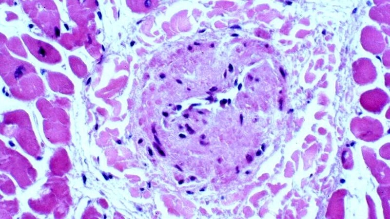 FMD patient support improving quality of life