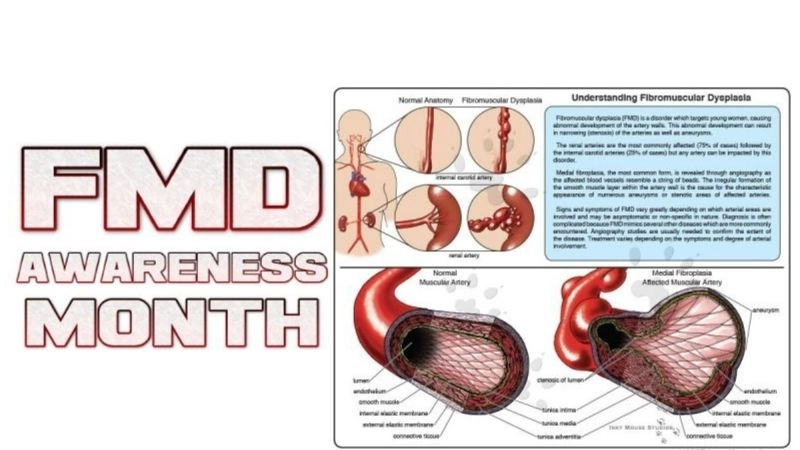 FMD vs atherosclerosis with distinct differences