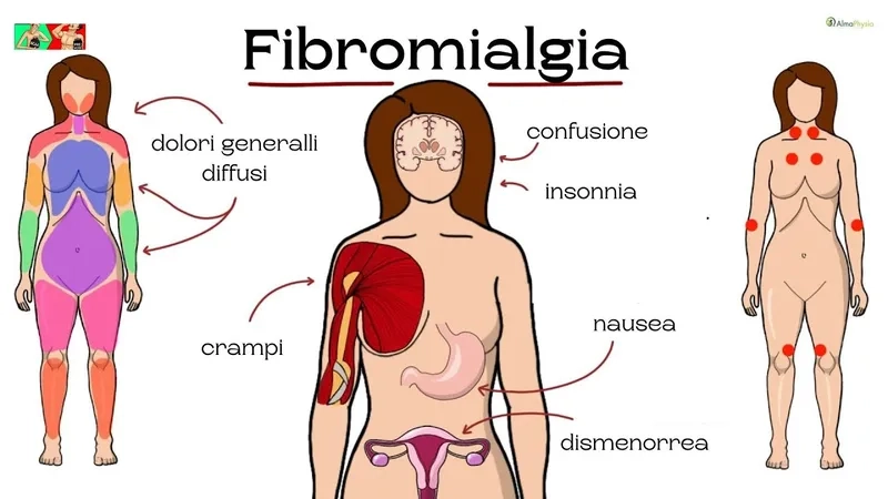 Illustrating the 18 fibromyalgia tender points