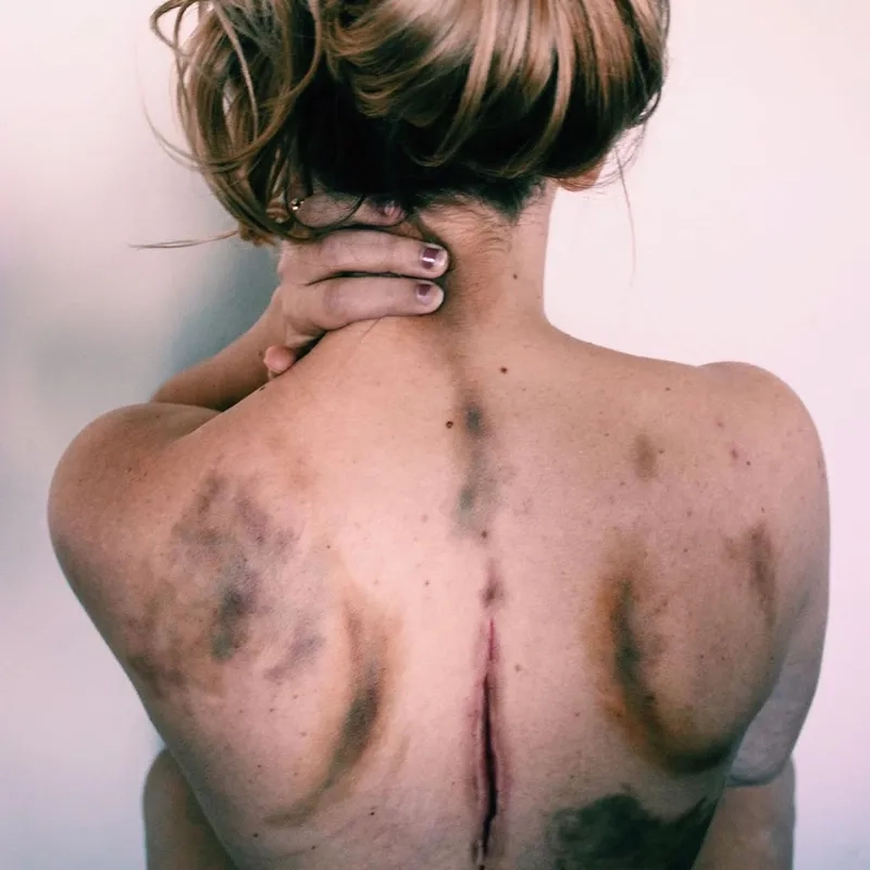 Understanding the key fibromyalgia symptoms