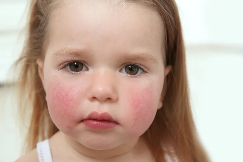 Erythema infectiosum fifth disease on a child's face