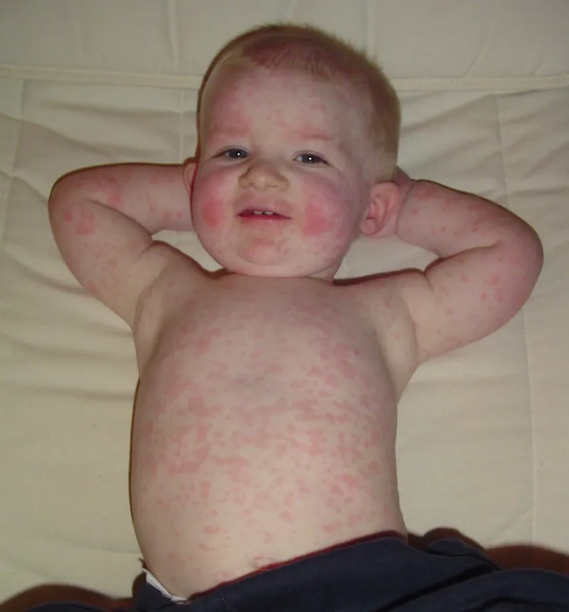 Child's red cheeks are classic symptoms of fifth disease