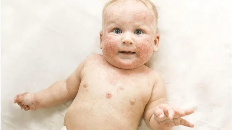 Answering the question: what is fifth disease