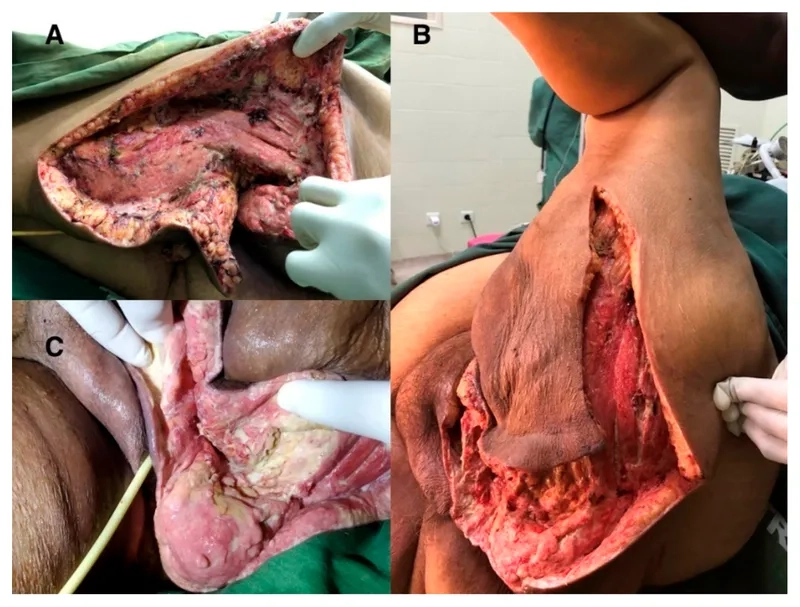Clinical signs showing Fournier's gangrene symptoms
