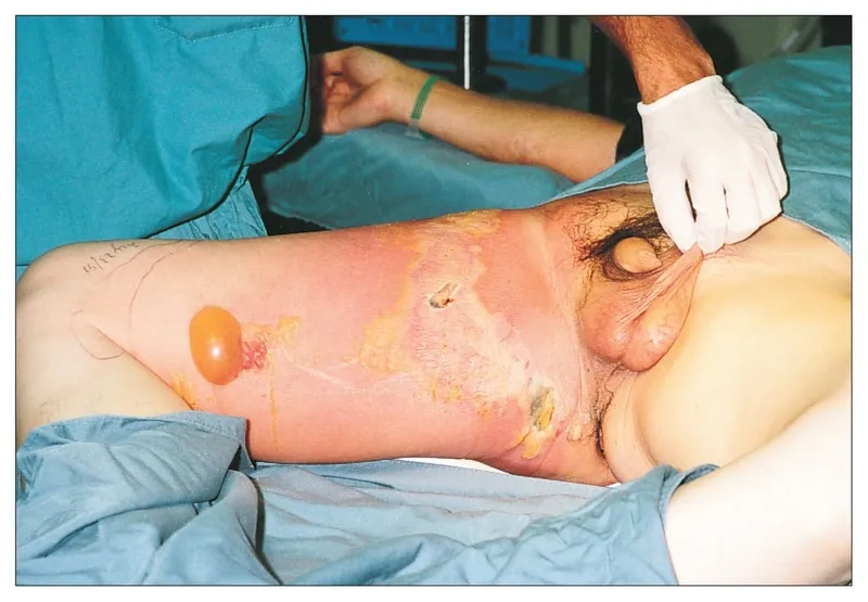 Diagram of flesh-eating disease affecting the groin