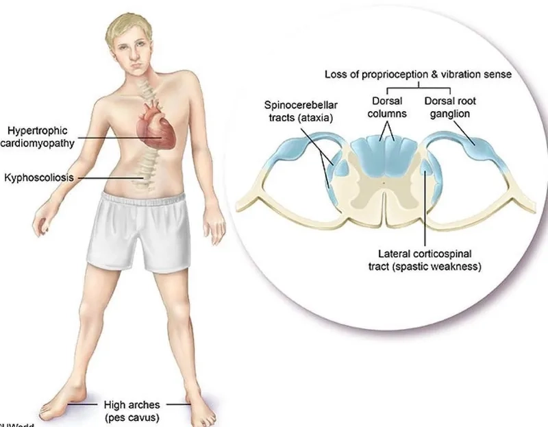 A diagram explaining what is Friedreich's ataxia